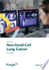 Fast_Facts__Non-Small-Cell_Lung_Cancer