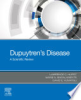 Dupuytren_s_disease